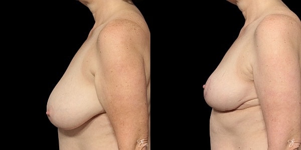 Breast Lift Before & After