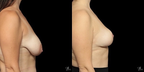 Breast Lift Before & After