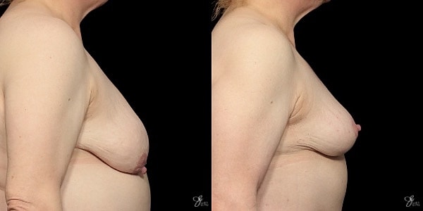 Breast Lift Before & After
