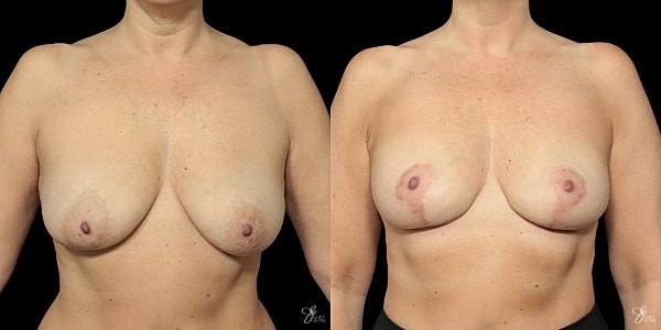 Breast Lift Before & After