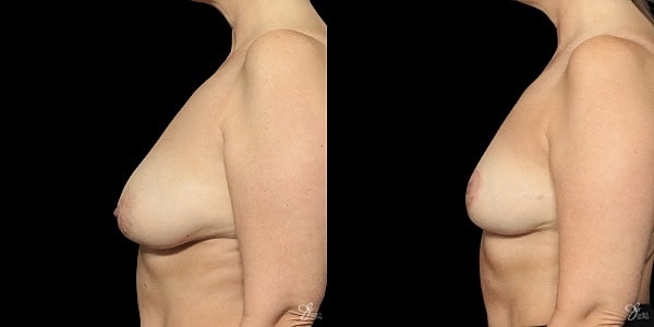 Breast Lift Before & After