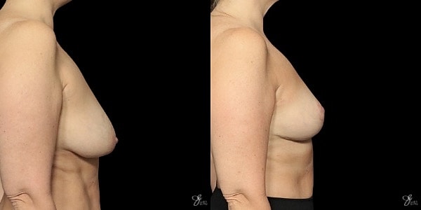 Breast Lift Before & After