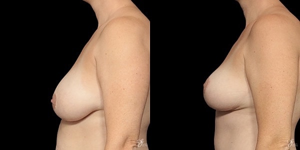 Breast Lift Before & After