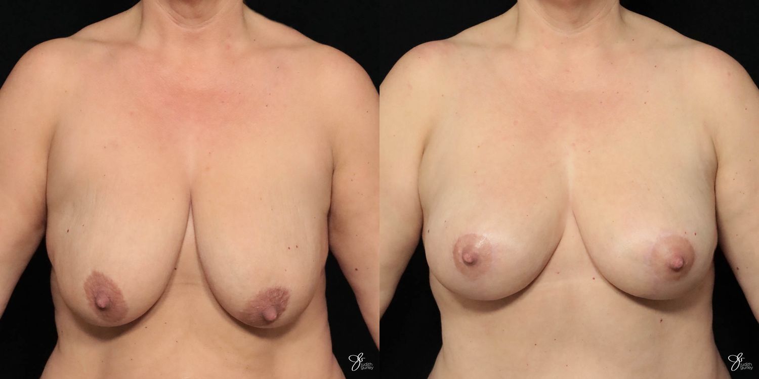 Breast Lift Before & After