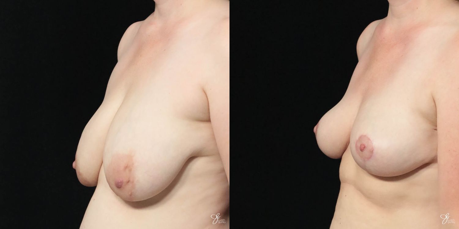 Breast Lift Before & After