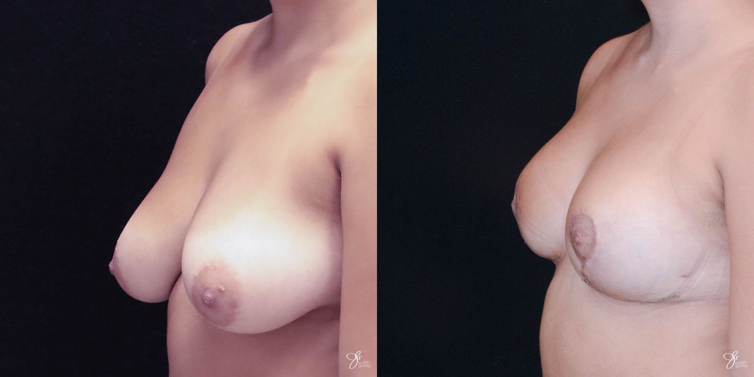 Breast Lift Before & After