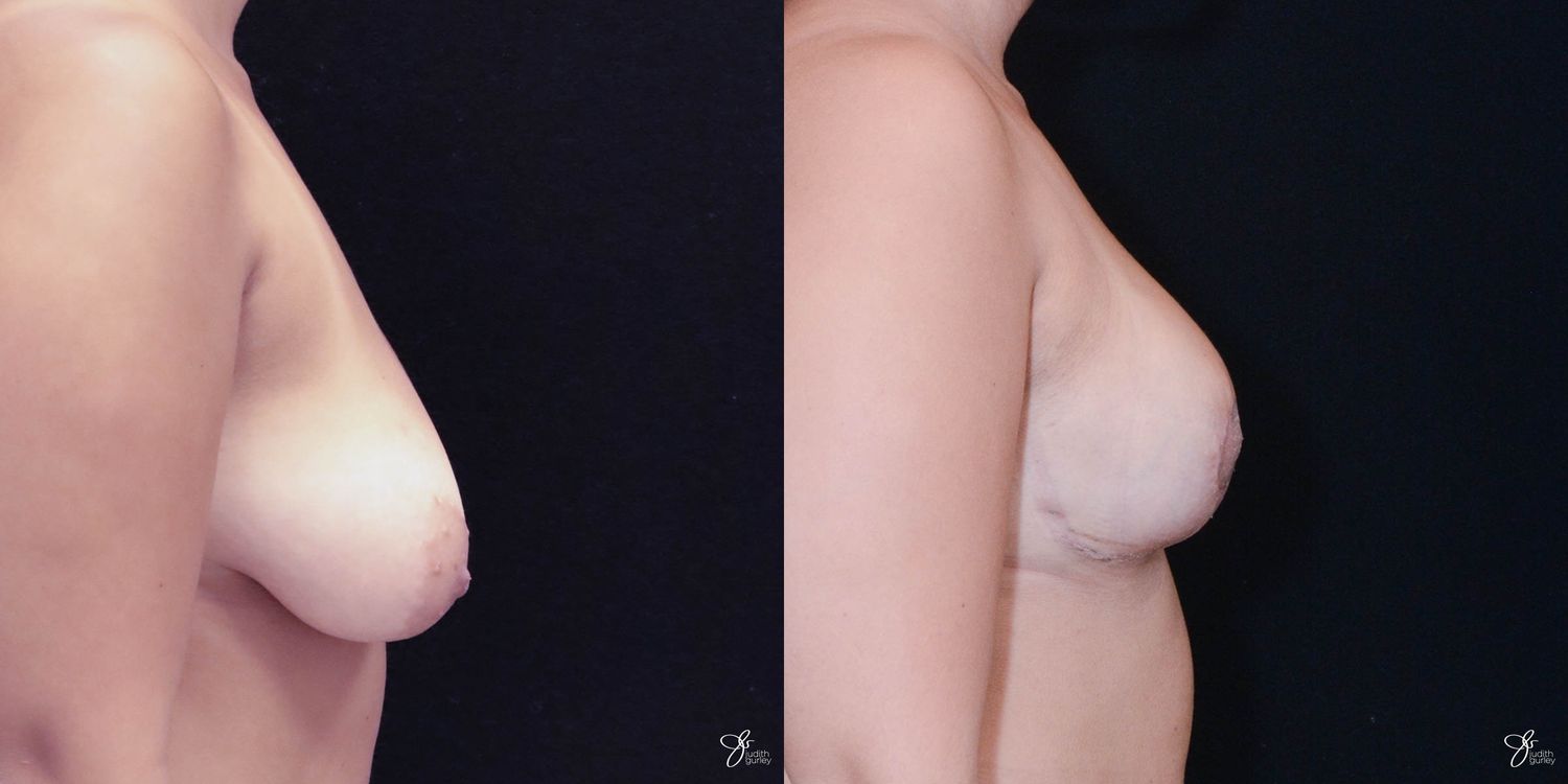 Breast Lift Before & After