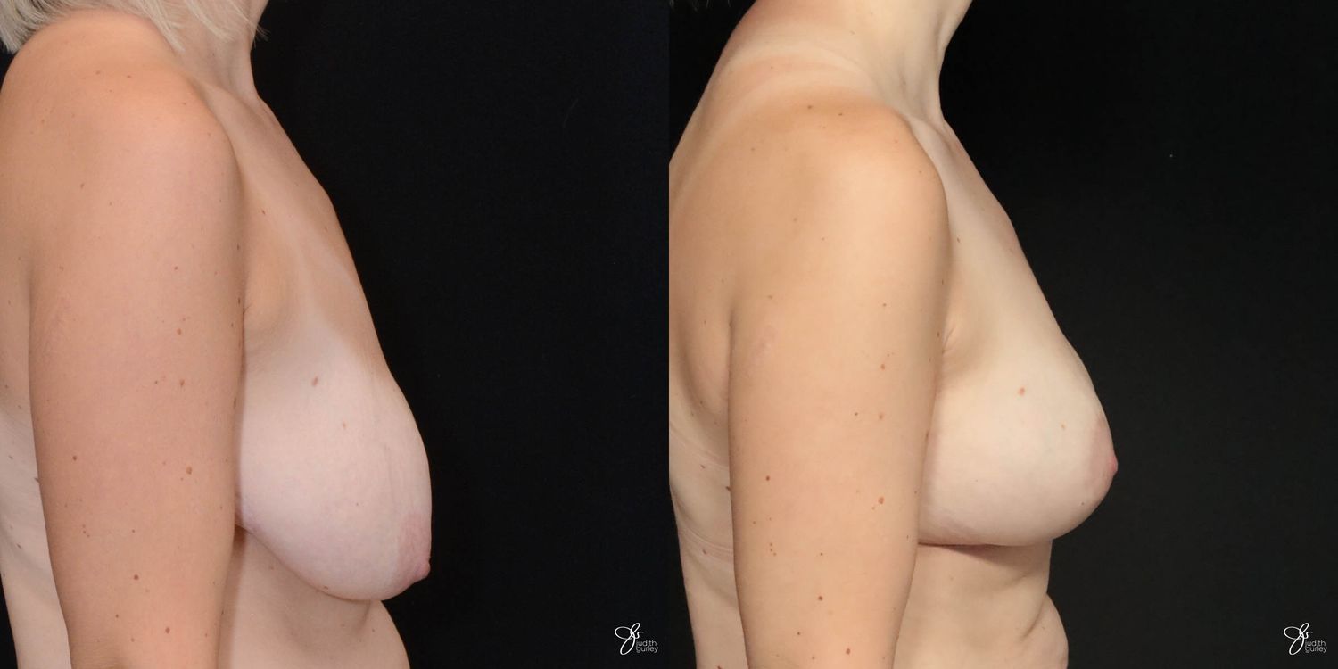 Breast Lift Before & After