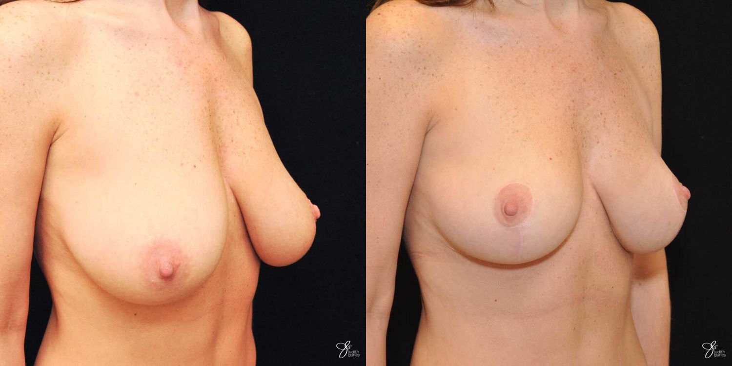 Breast Lift Before & After