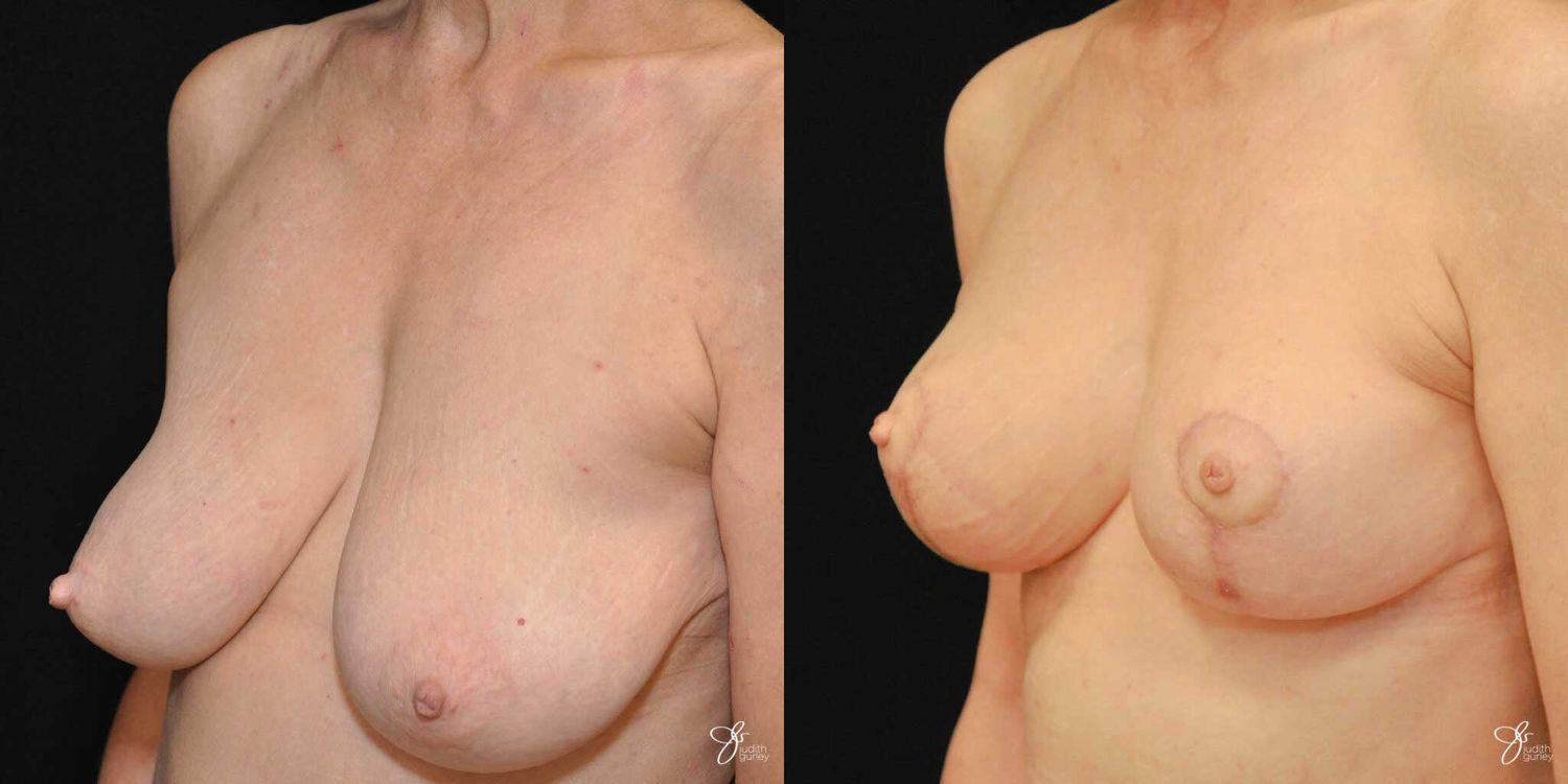 Breast Lift Before & After