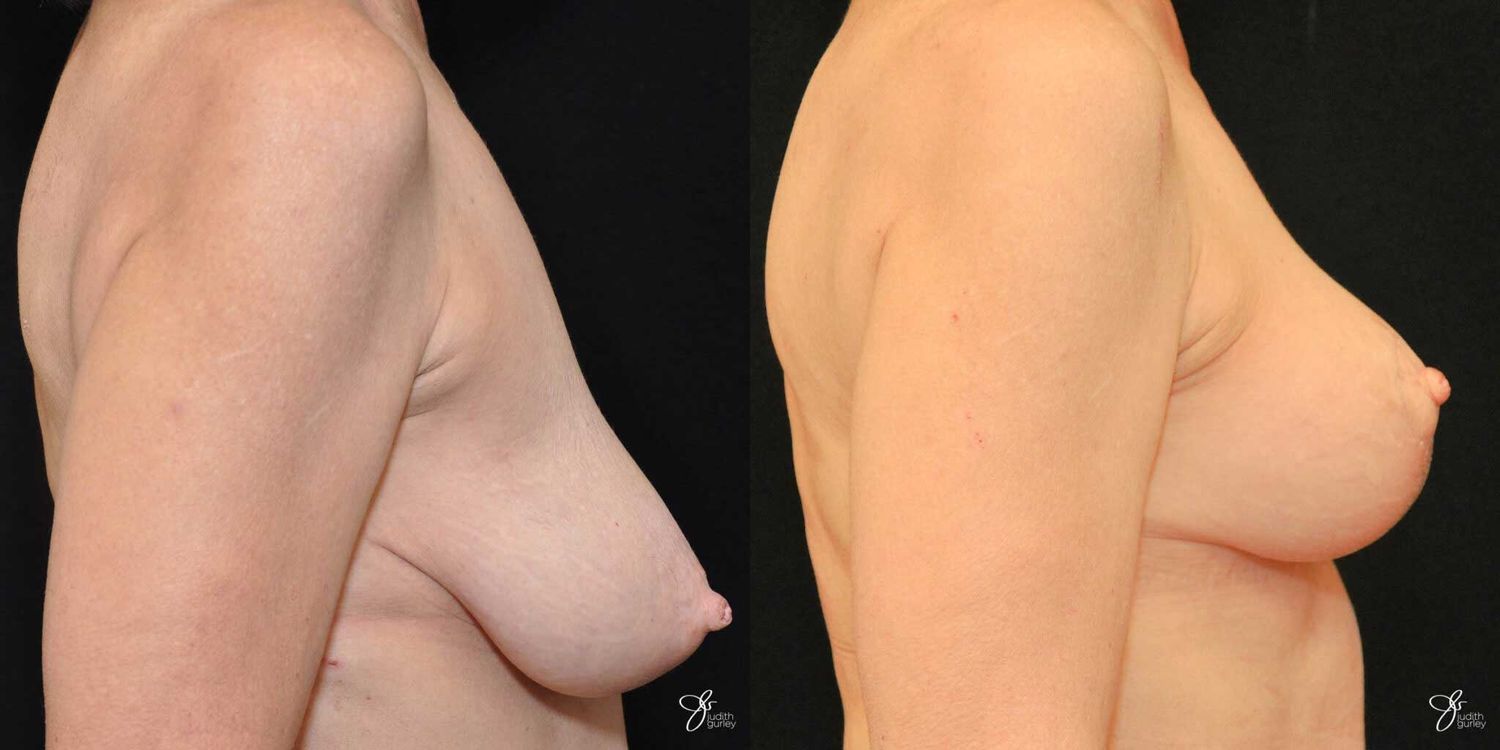 Breast Lift Before & After