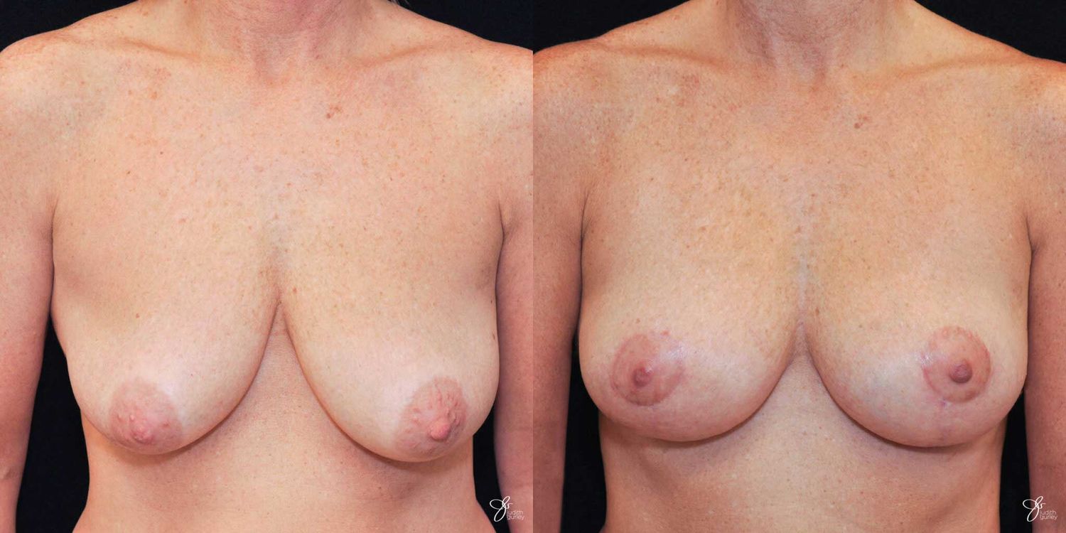 Breast Lift Before & After