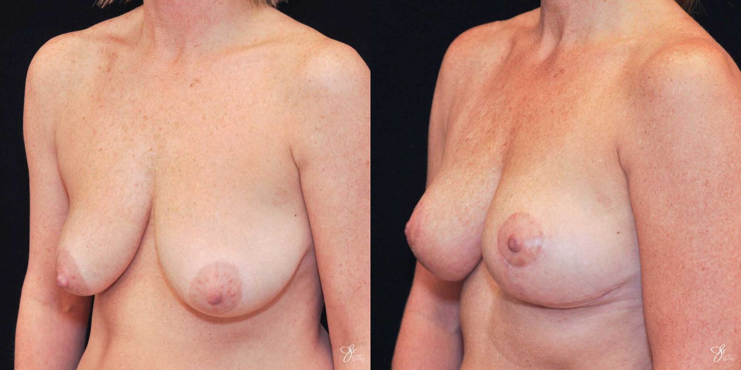 Breast Lift Before & After