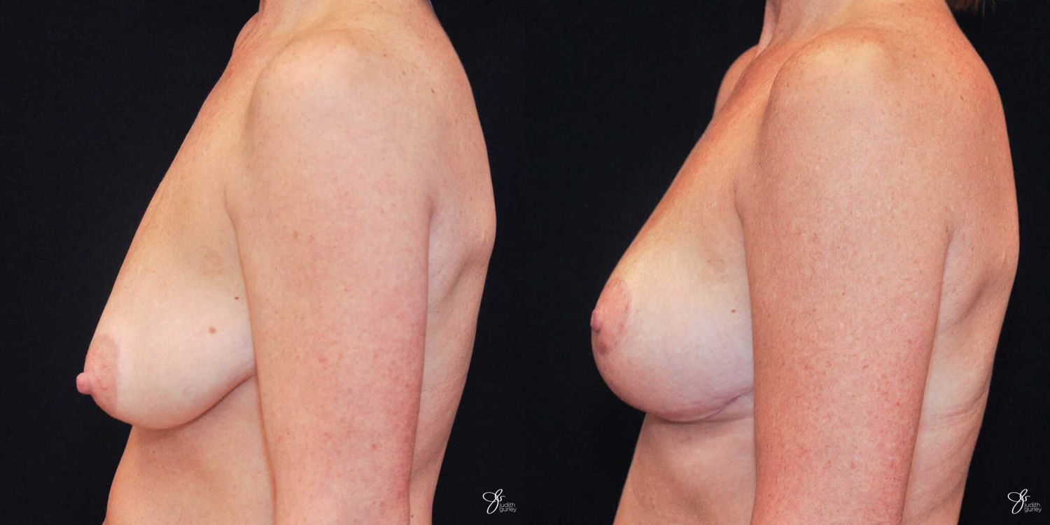 Breast Lift Before & After