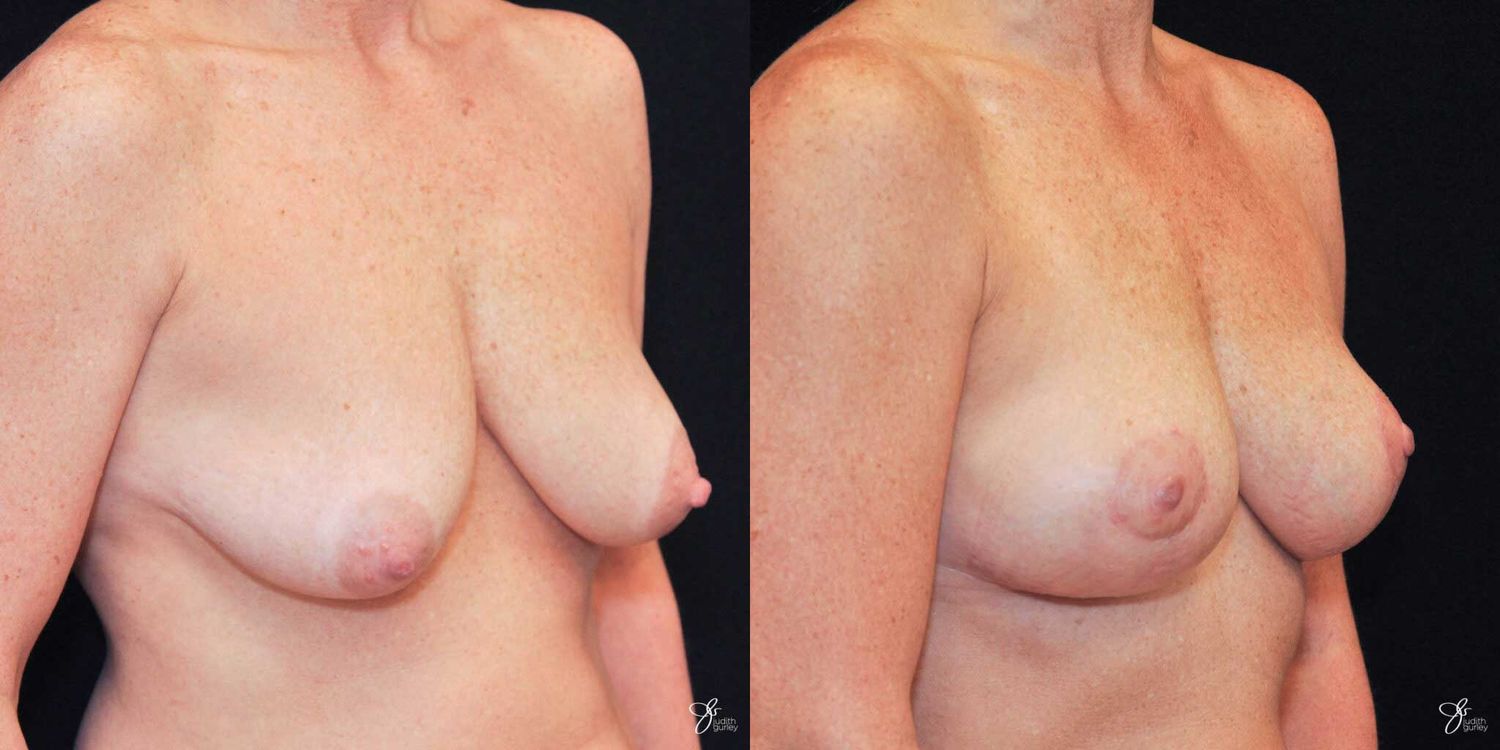 Breast Lift Before & After