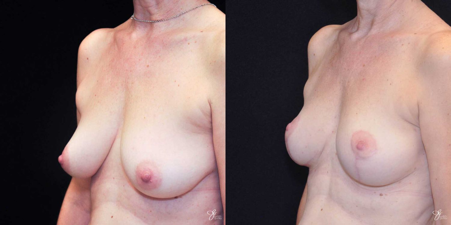 Breast Lift Before & After