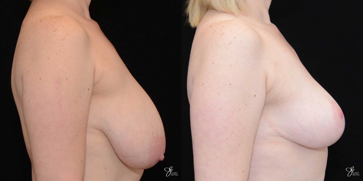 Breast Lift Before & After