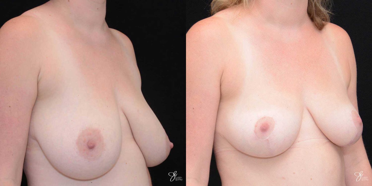 Breast Lift Before & After