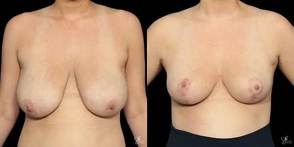 Breast Lift Before & After