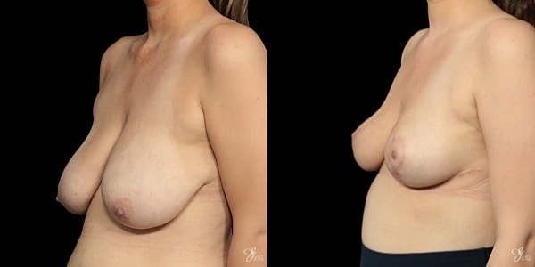 Breast Lift Before & After