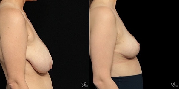Breast Lift Before & After