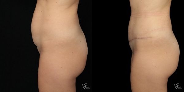 Tummy Tuck Before & After