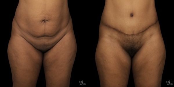 Tummy Tuck Before & After