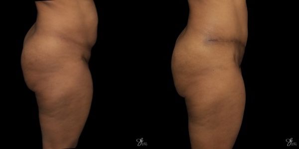 Tummy Tuck Before & After