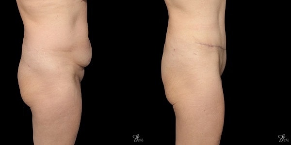 Tummy Tuck Before & After