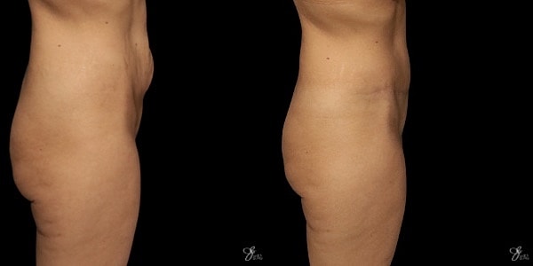 Tummy Tuck Before & After