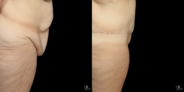 Tummy Tuck Before & After