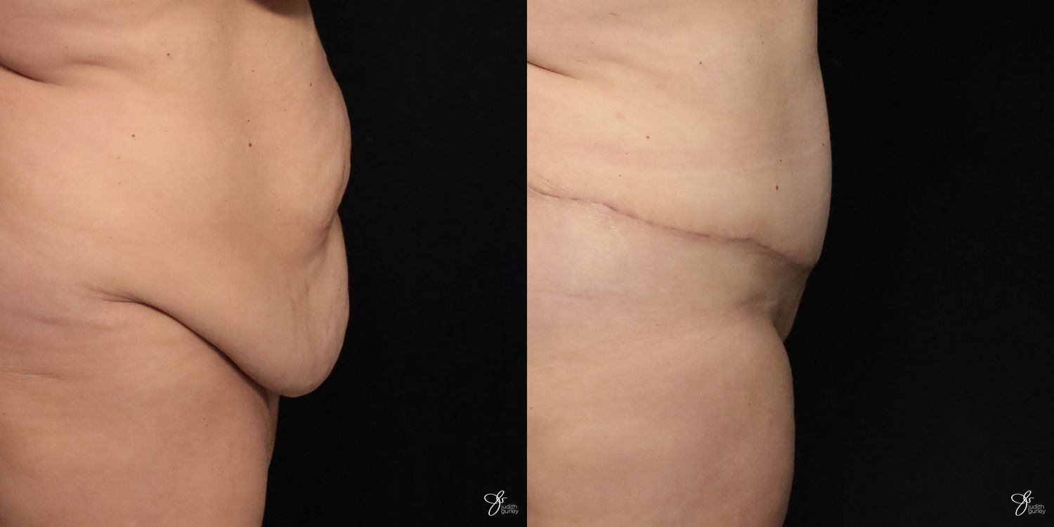 Tummy Tuck Before & After