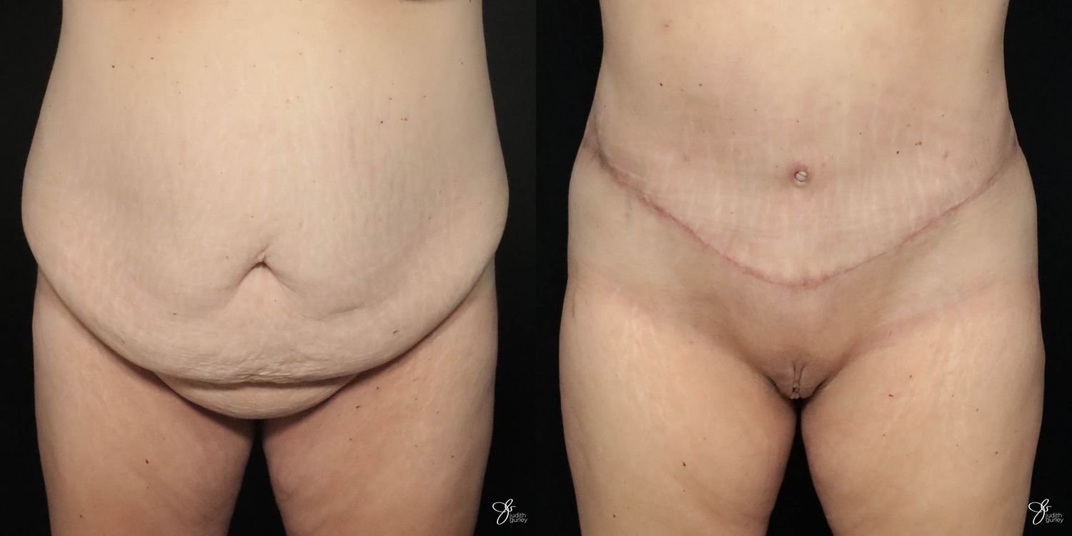 Tummy Tuck Before & After