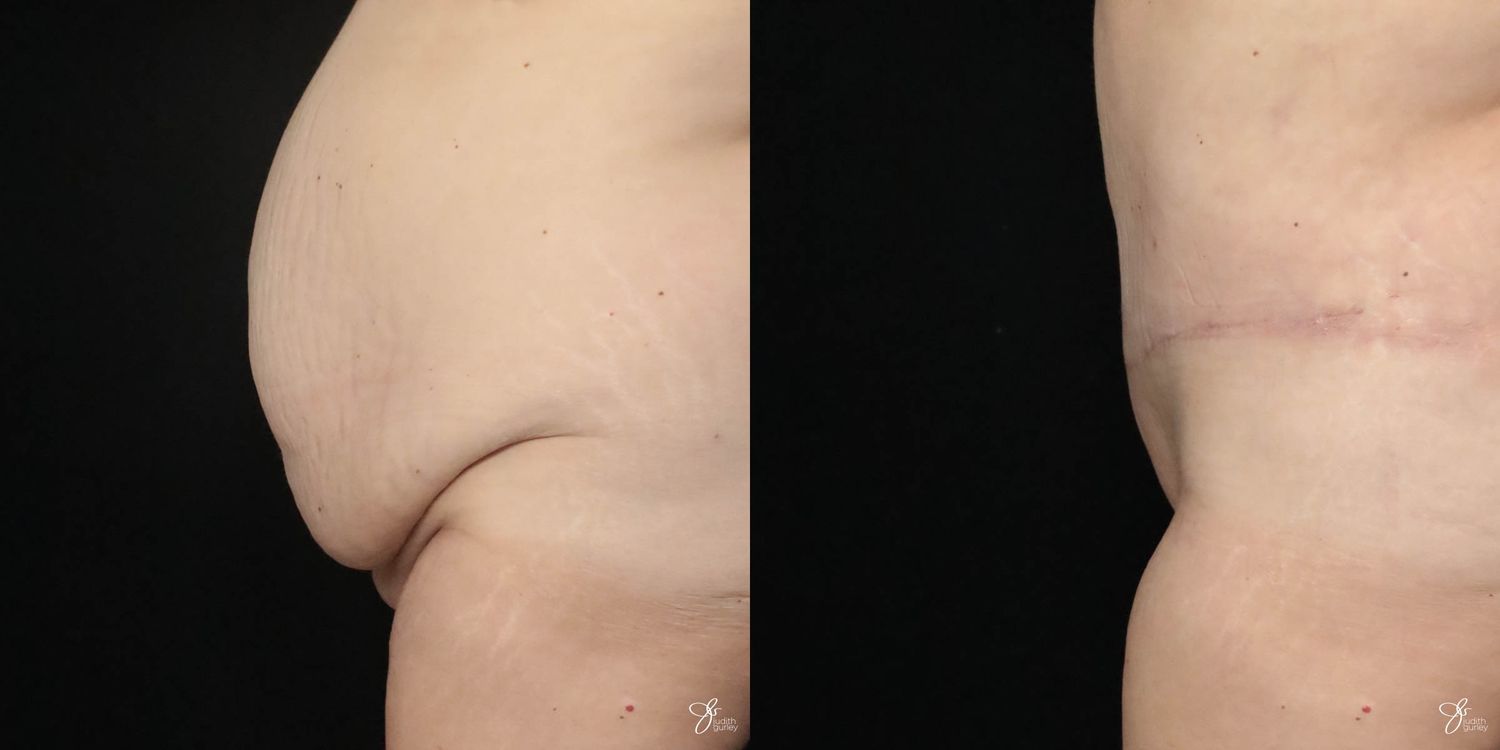 Tummy Tuck Before & After