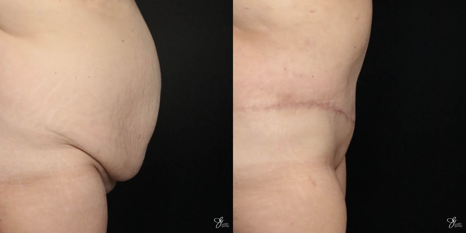 Tummy Tuck Before & After