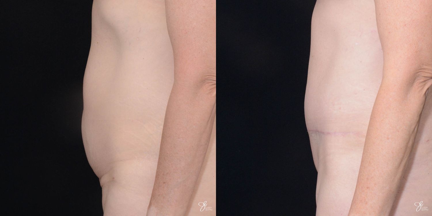 Tummy Tuck Before & After