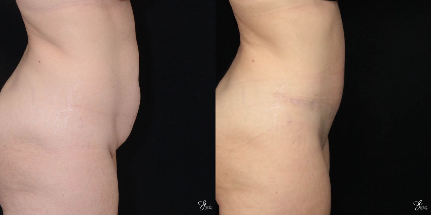 Tummy Tuck Before & After
