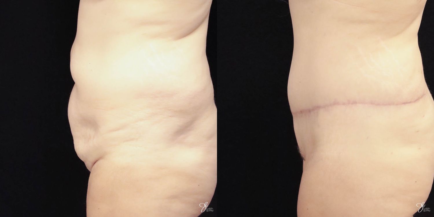 Tummy Tuck Before & After