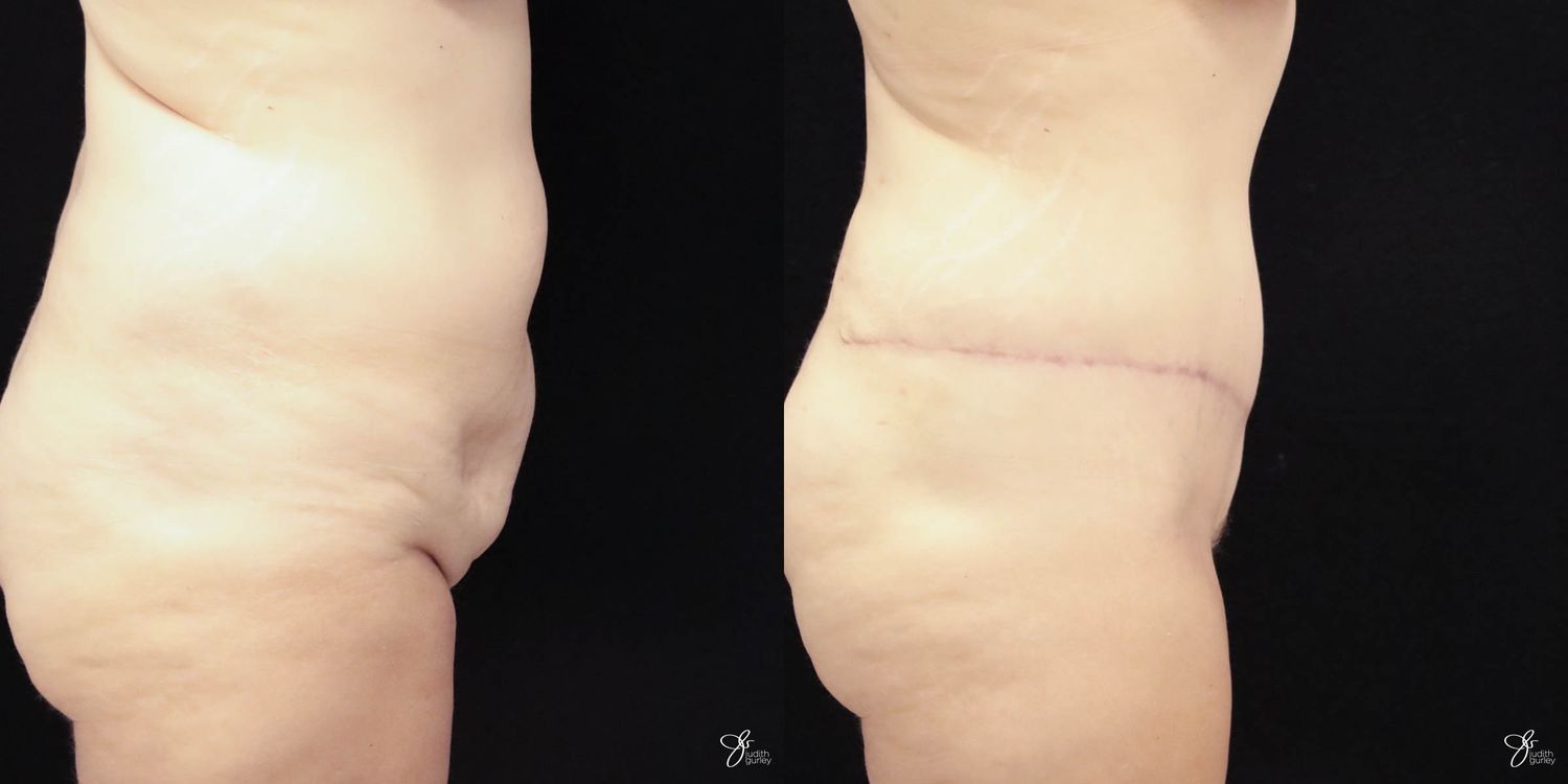 Tummy Tuck Before & After