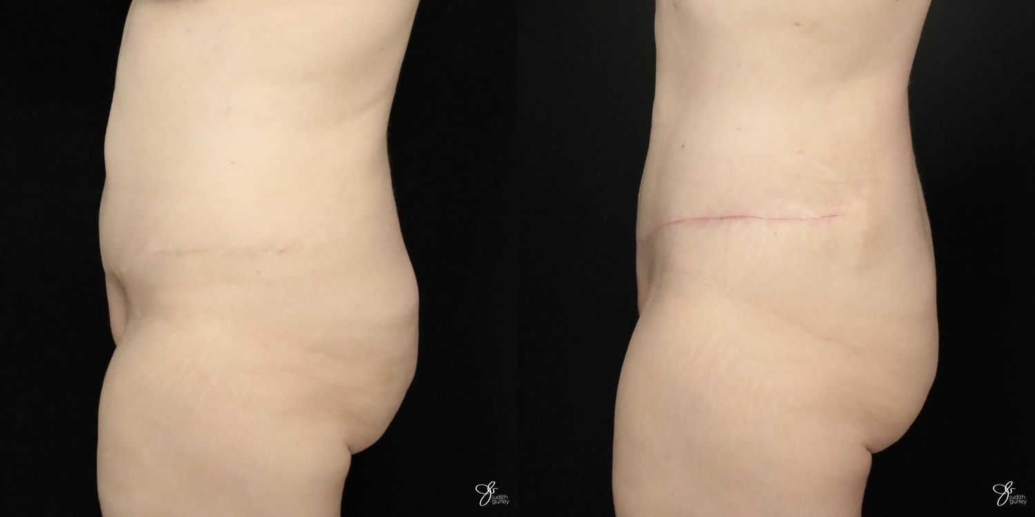 Tummy Tuck Before & After