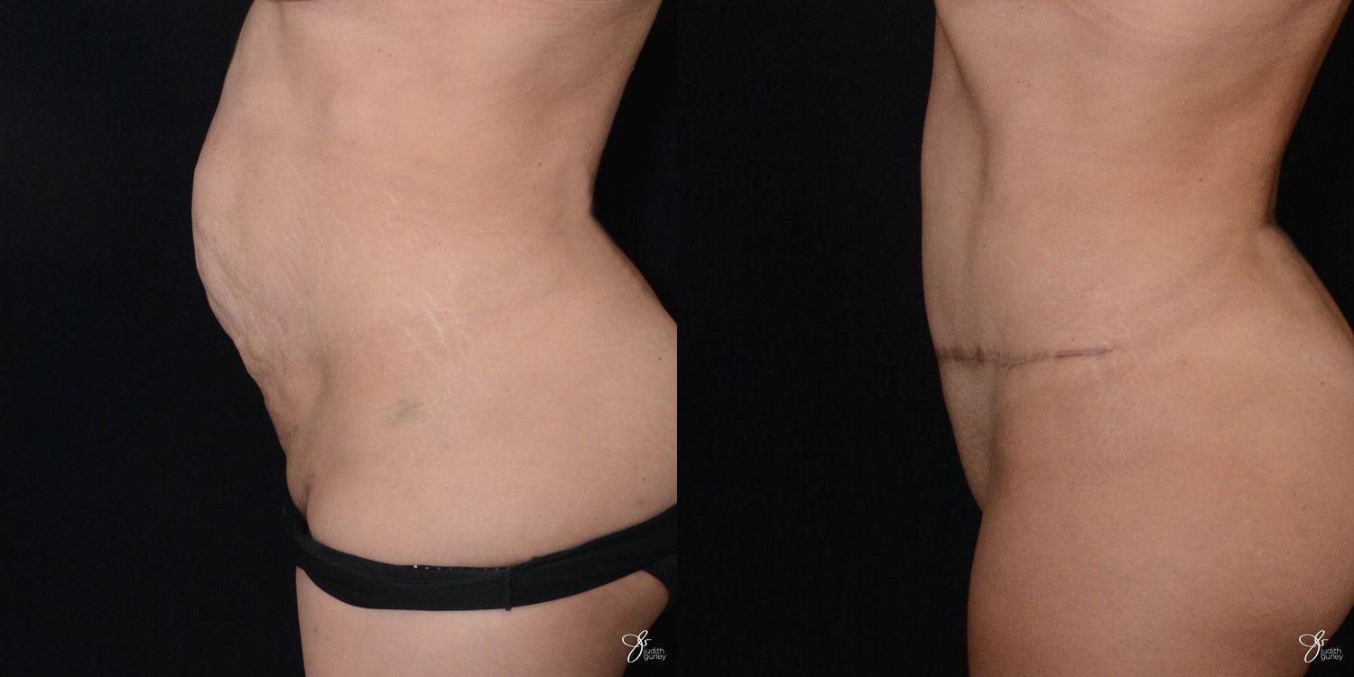 Tummy Tuck Before & After
