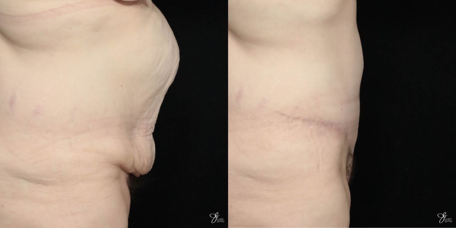 Tummy Tuck Before & After