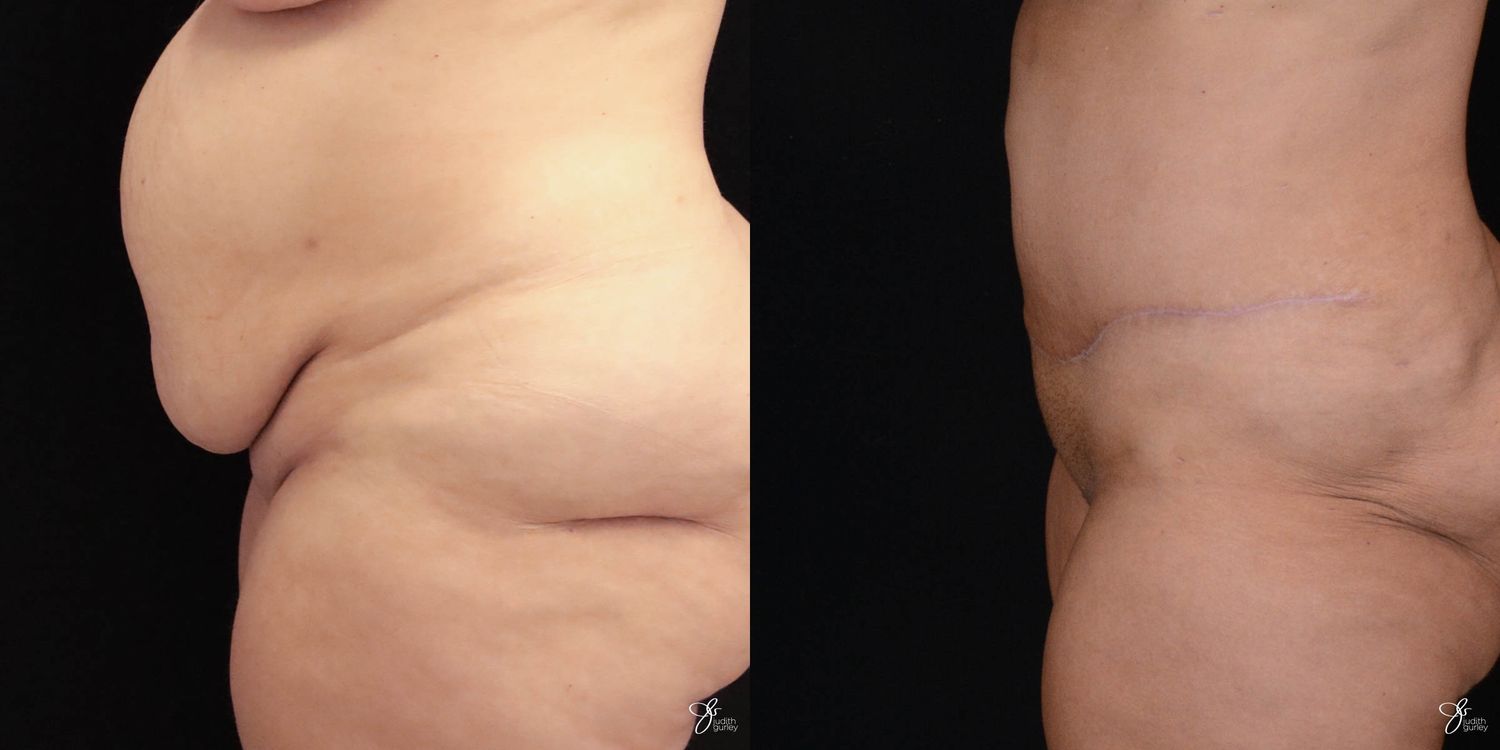 Tummy Tuck Before & After