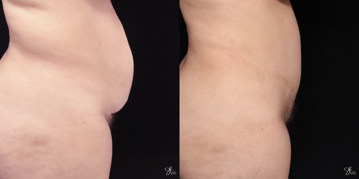 Tummy Tuck Before & After