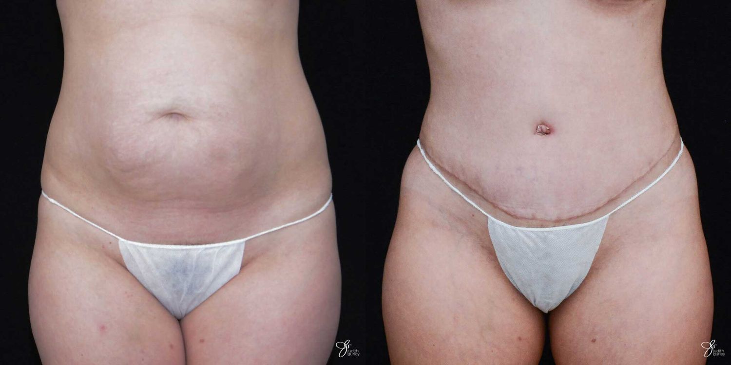 Tummy Tuck Before & After