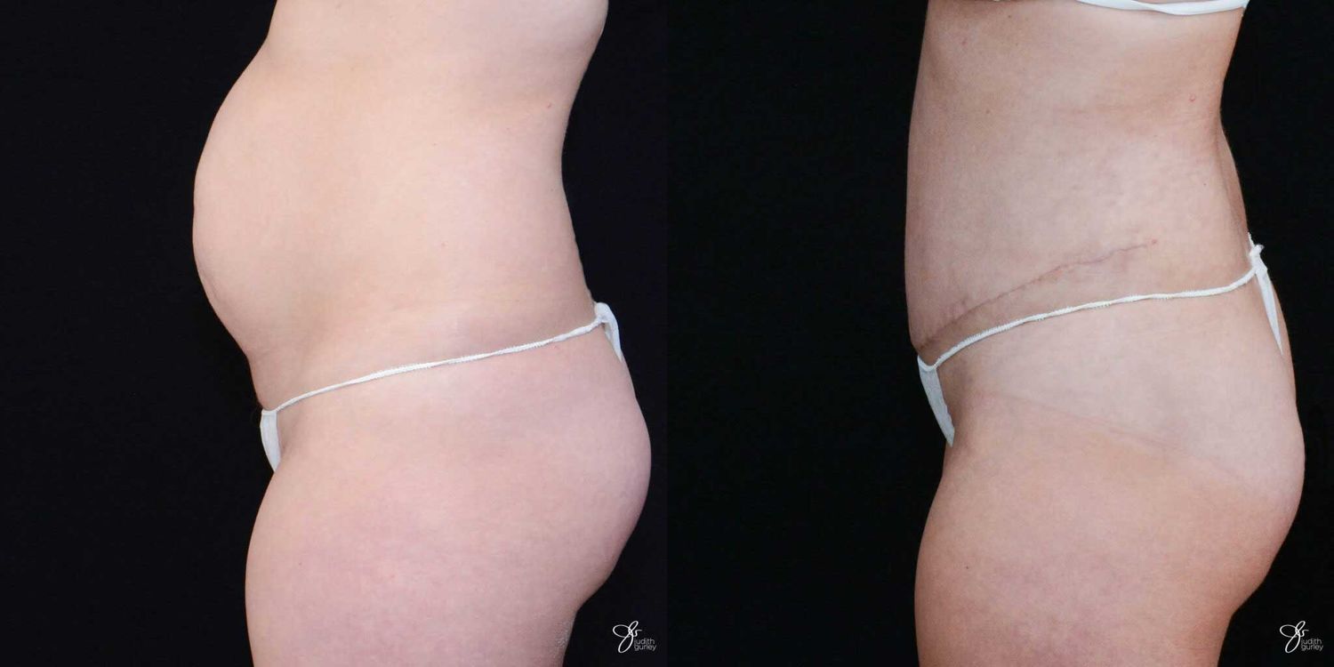 Tummy Tuck Before & After