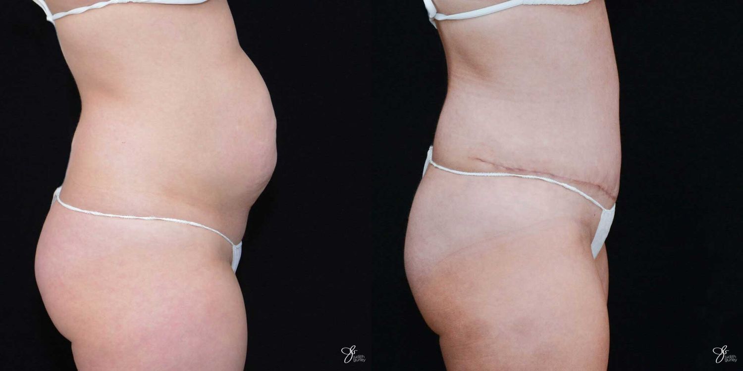 Tummy Tuck Before & After