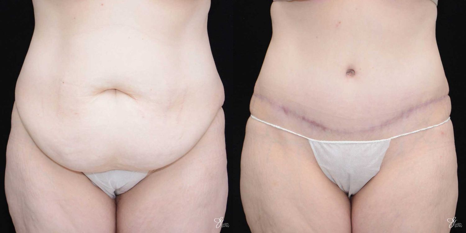 Tummy Tuck Before & After