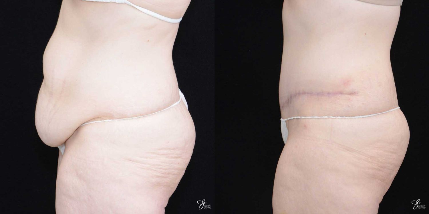 Tummy Tuck Before & After