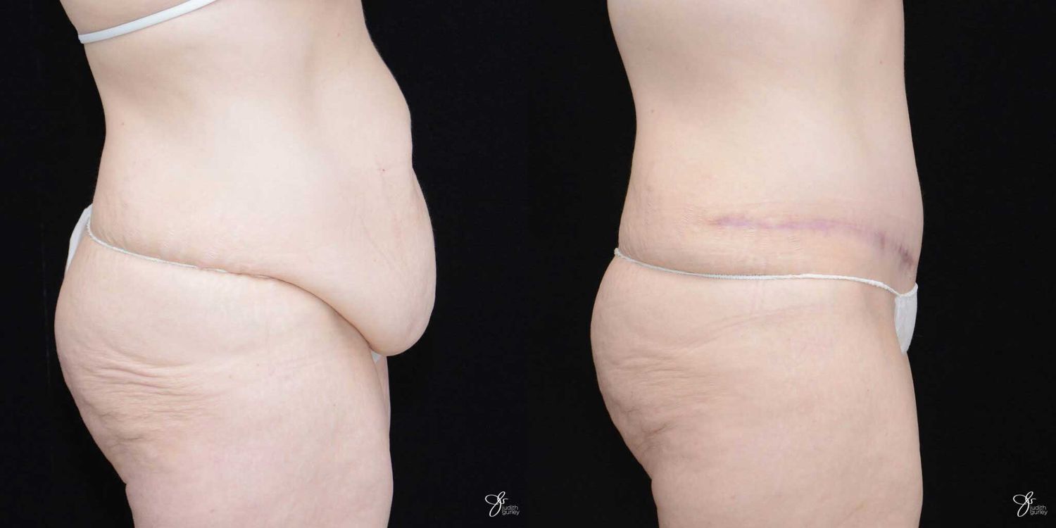 Tummy Tuck Before & After